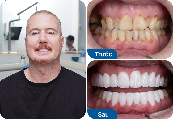 Chú Tim Baker bọc 20 răng sứ Nacera Pearl tại nha khoa I-Dent.