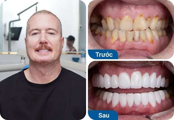 Chú Tim Baker bọc 20 răng sứ Nacera Pearl tại nha khoa I-Dent.