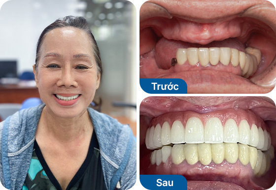 Cô Thu Hương trồng răng Implant All on 5 hàm trên tại nha khoa I-Dent.