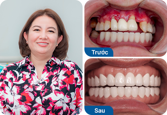 Cô Ngọc Quyên trồng răng implant All on 4 hàm dưới, All on 5 hàm trên tại nha khoa I-Dent.