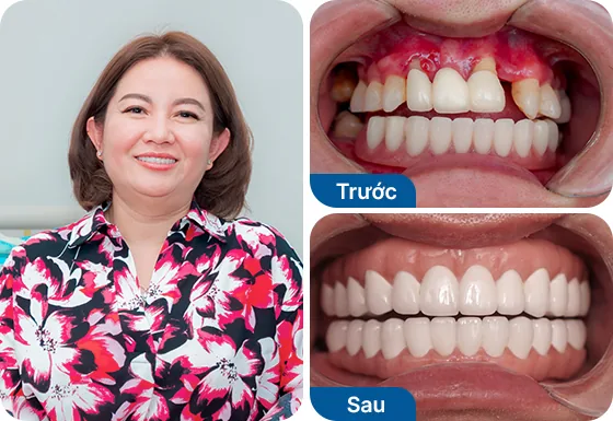 Cô Ngọc Quyên trồng răng implant All on 4 hàm dưới, All on 5 hàm trên tại nha khoa I-Dent.