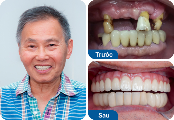 Chú Tony Cường Hoàng cấy implant toàn hàm All-on-4 tại nha khoa I-Dent.