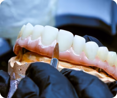 Nha khoa I-Dent ứng dụng kỹ thuật chế tác răng sứ Multilayer mang lại thẩm mỹ vượt trội.