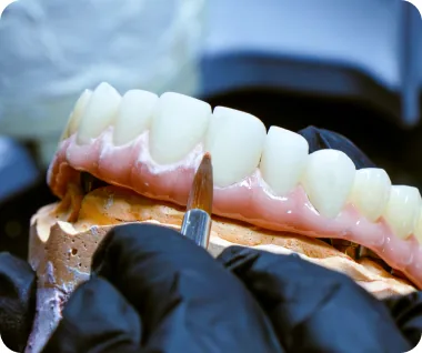 Nha khoa I-Dent ứng dụng kỹ thuật chế tác răng sứ Multilayer mang lại thẩm mỹ vượt trội.