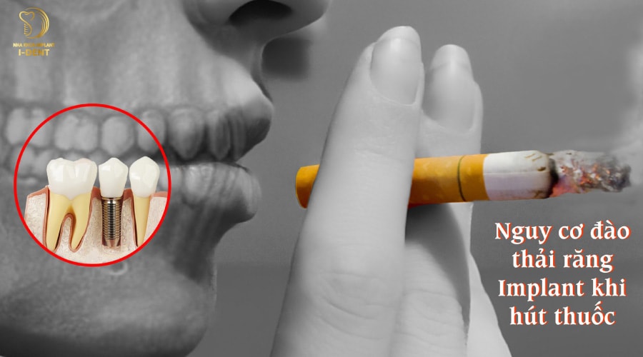 Người hút thuốc lá không thể cấy Implant