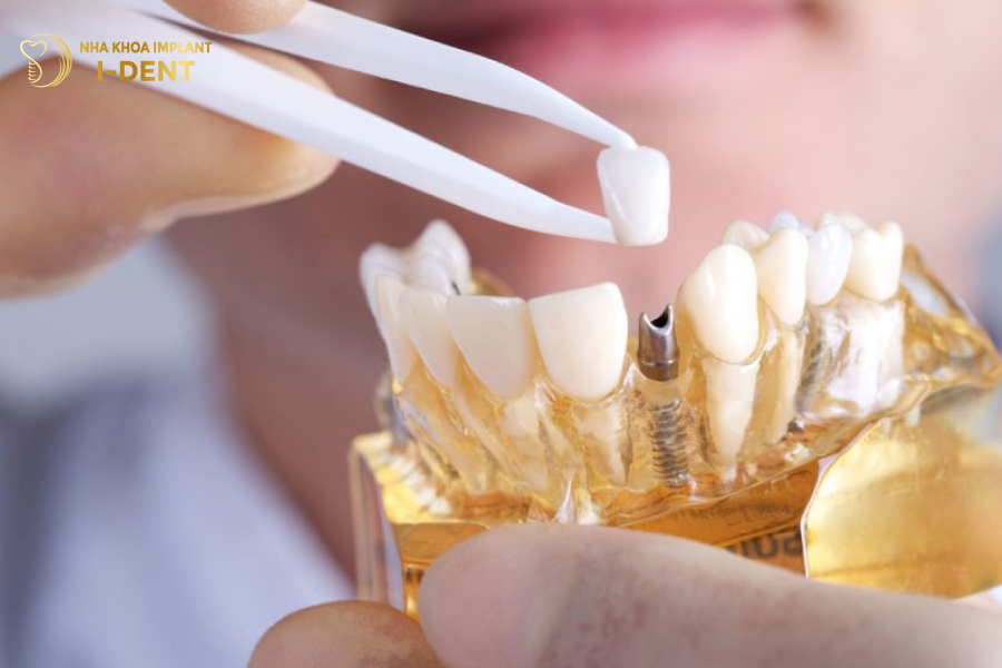 làm răng implant mất bao nhiêu thời gian