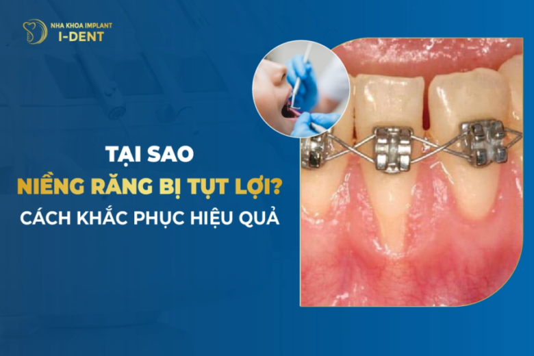 Bị tụt lợi khi niềng răng cần làm gì để khắc phục ngay