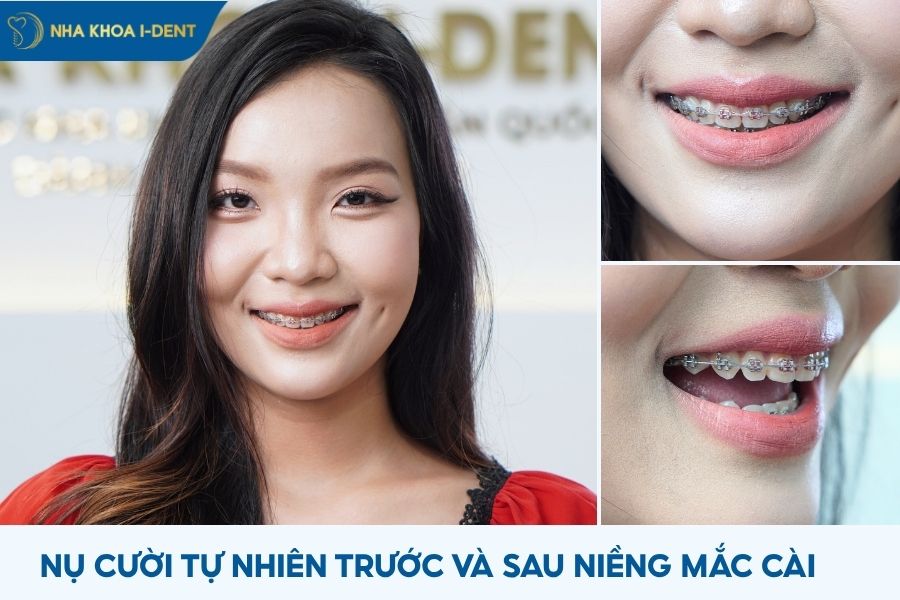 niềng răng mắc cài