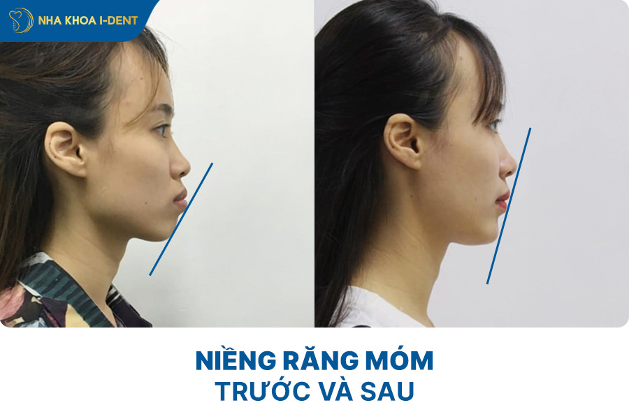 ảnh trước và sau khi niềng răng móm