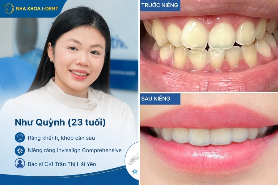 Hình ảnh trước và sau khi điều trị niềng răng trong suốt