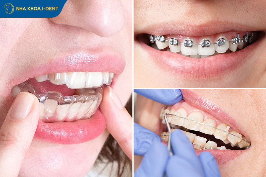 móm có nên niềng răng