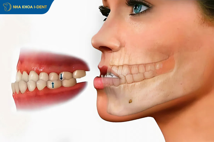 bị móm có nên niềng răng