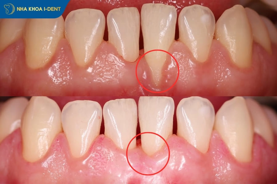 niềng răng bị tụt lợi