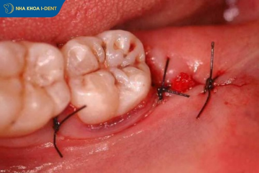 biến chứng nhổ răng khôn hàm dưới