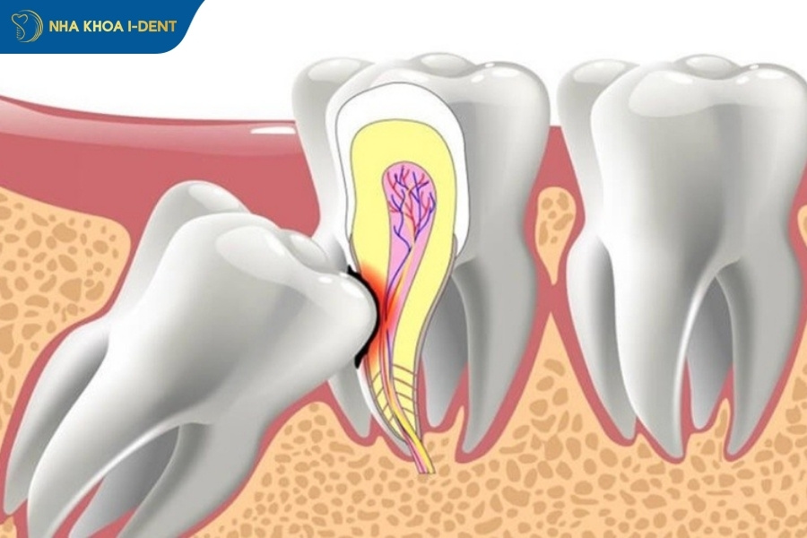 biến chứng nhổ răng khôn hàm trên