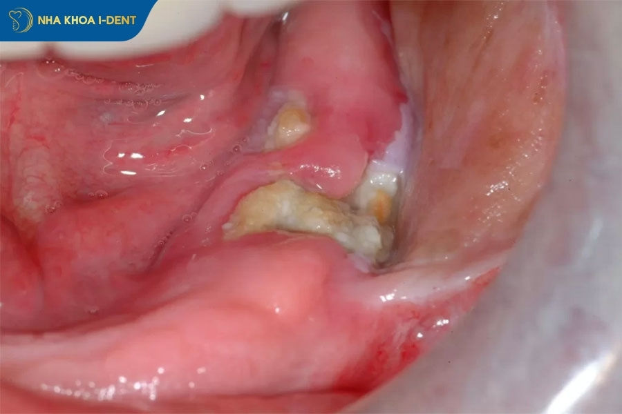 biến chứng sau khi nhổ răng khôn