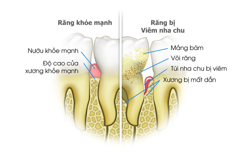 nhổ răng không trồng lại có sao không