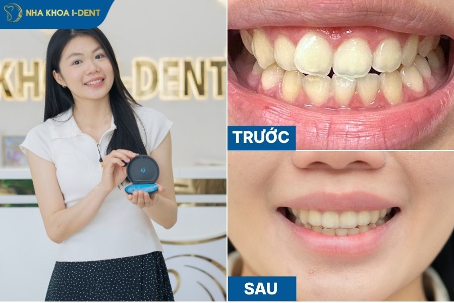 các cách niềng răng