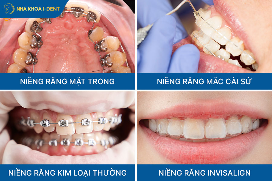 Mỗi các cách niềng răng sẽ có tính thẩm mỹ, thời gian niềng và chi phí khác nhau