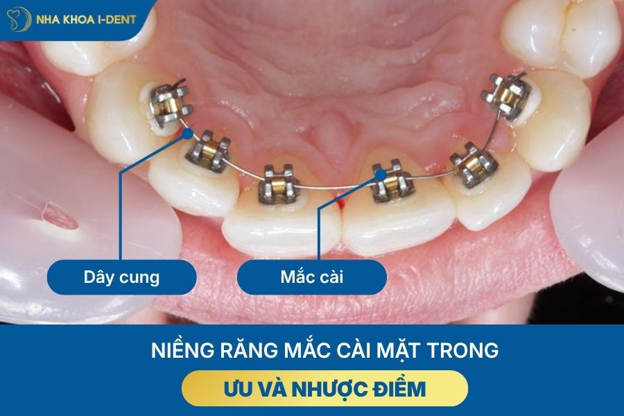 các loại mắc cài niềng răng