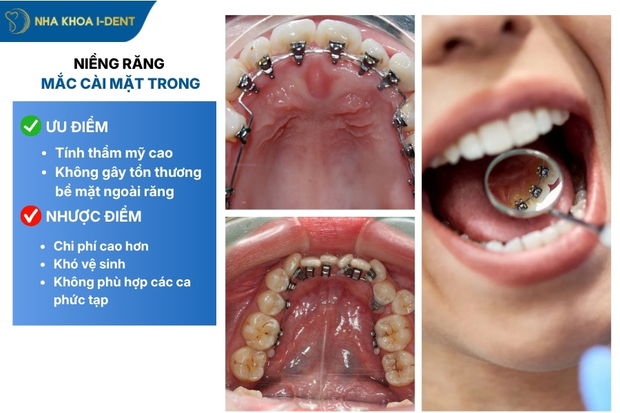 các loại mắc cài