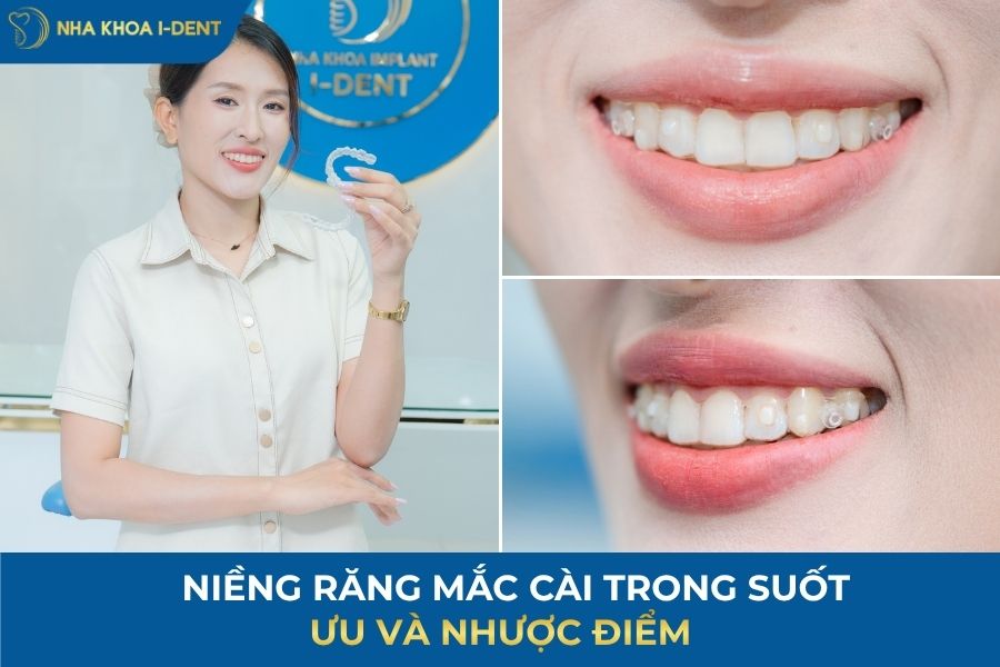 các loại mắc cài niềng răng