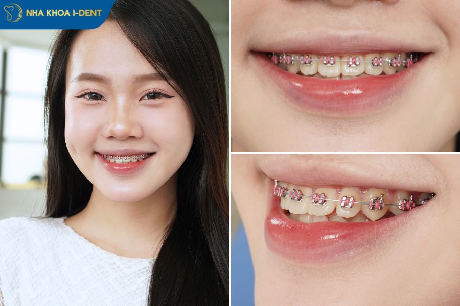 các loại mắc cài phổ biến