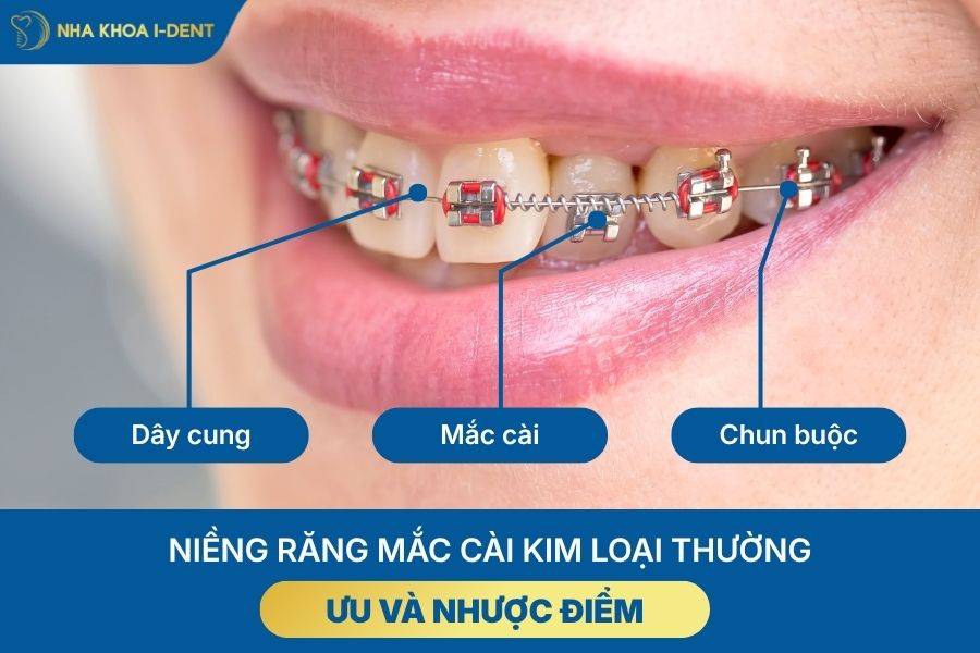 Niềng răng mắc cài kim loại