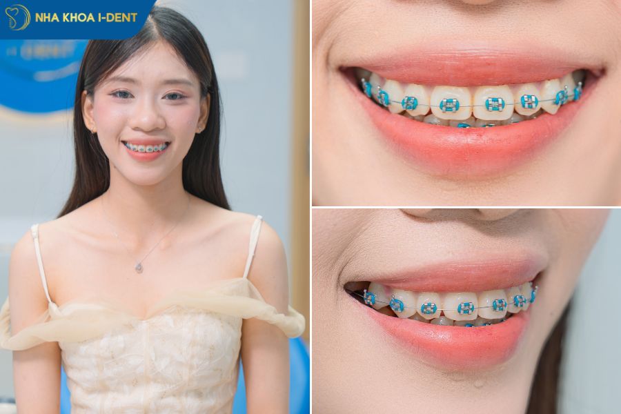 các loại mắc cài trong niềng răng