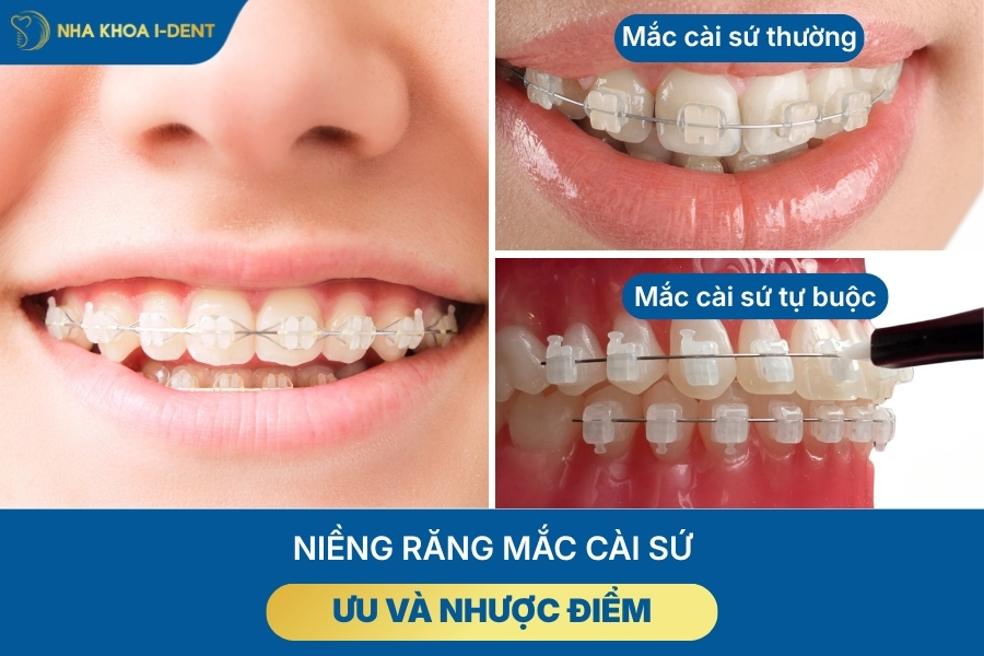 Sử dụng mắc cài sứ mang đến thẩm mỹ cao