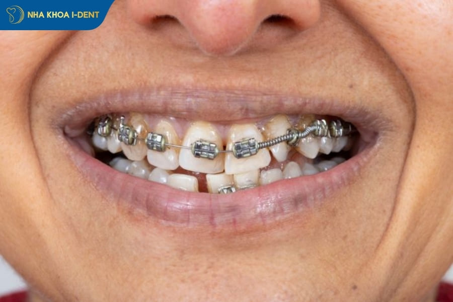 các lưu ý quan trọng khi niềng răng