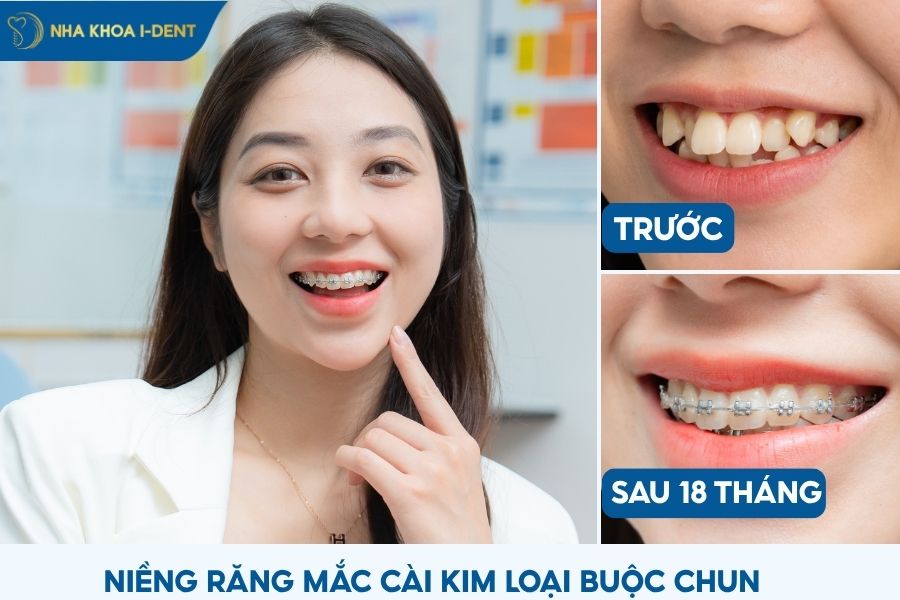 phương pháp niềng răng buộc chun