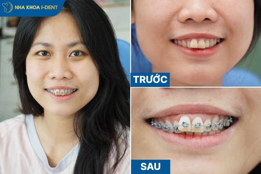 các phương pháp niềng răng hiện nay