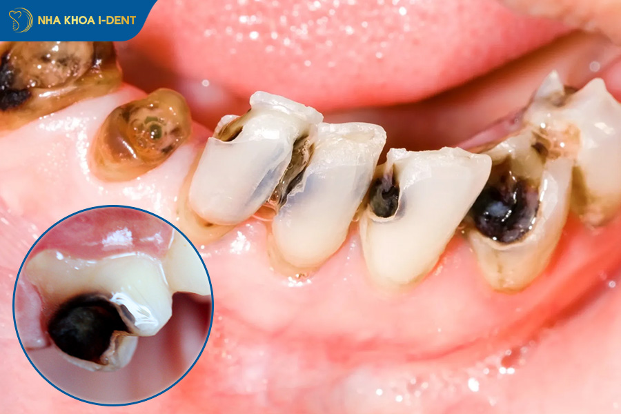 cách nhổ răng không đau