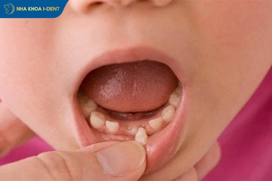 cách nhổ răng sữa