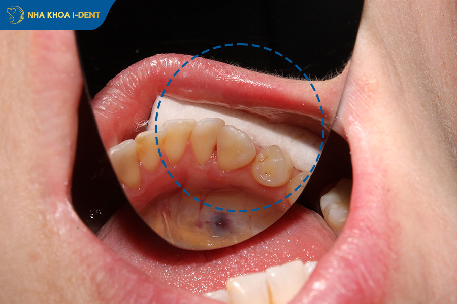 cách vệ sinh sau khi nhổ răng khôn