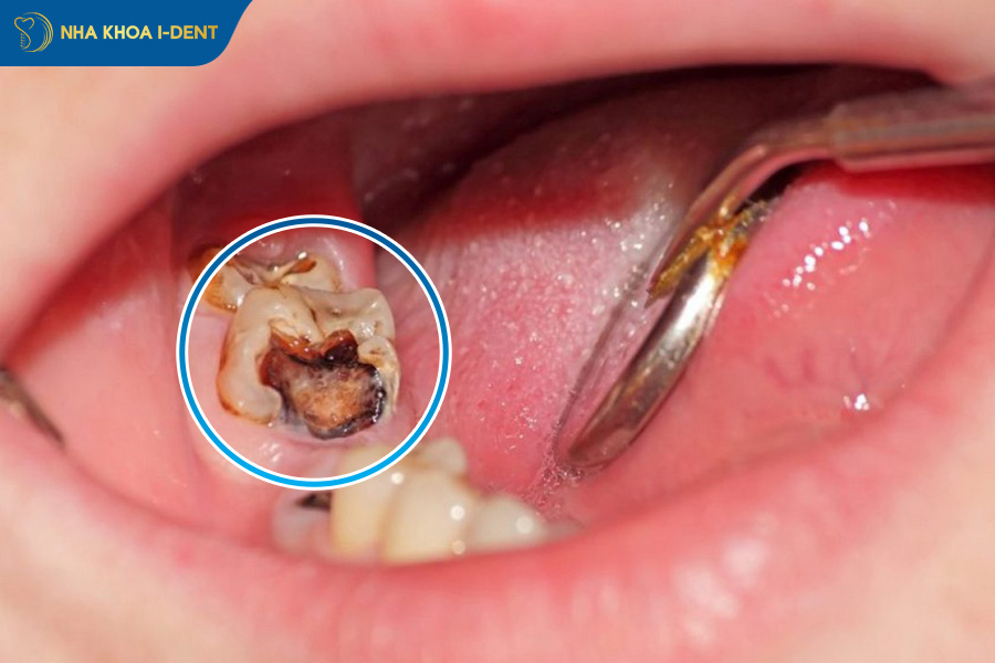 cảm giác sau khi bọc răng sứ