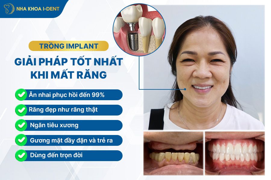 cắm implant