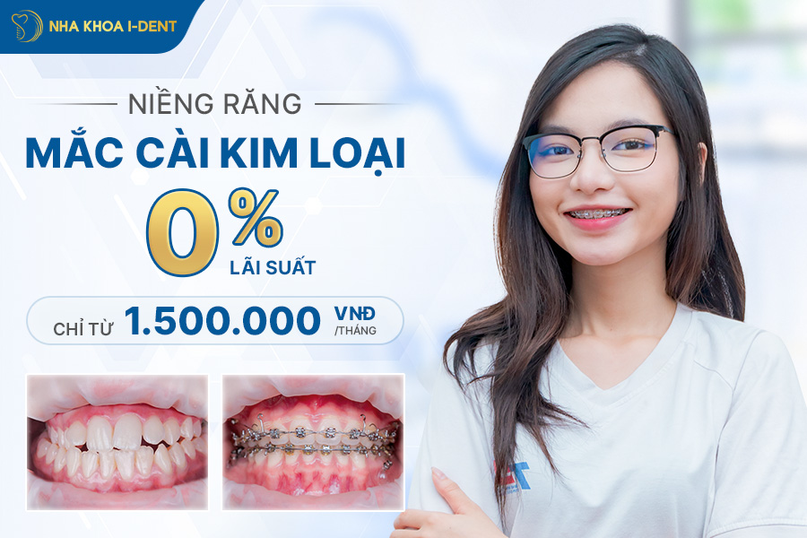 niềng răng mắc cài kim loại giá bao nhiêu