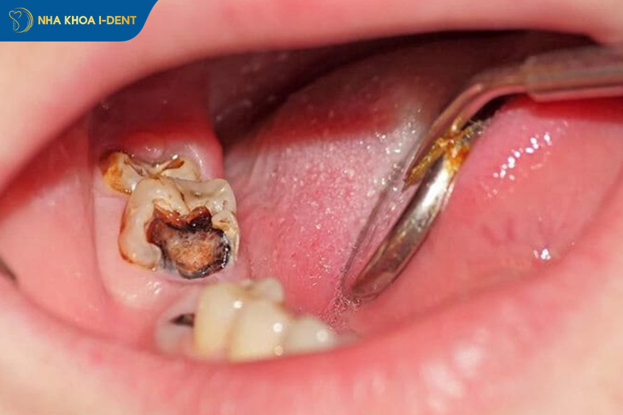 có nên bọc răng sứ