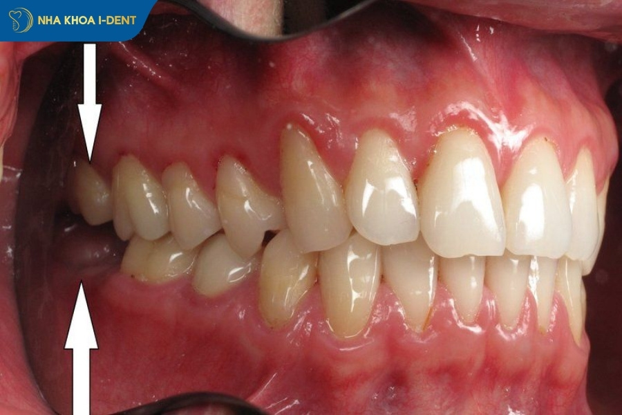 có nên nhổ răng số 8 hàm trên không