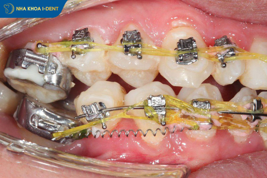 niềng răng xong vẫn xấu