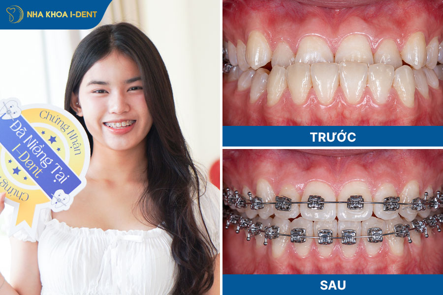 giá niềng răng mắc cài kim loại