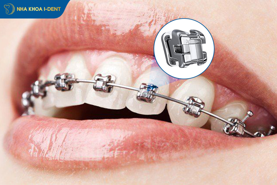 giá niềng răng mắc cài kim loại