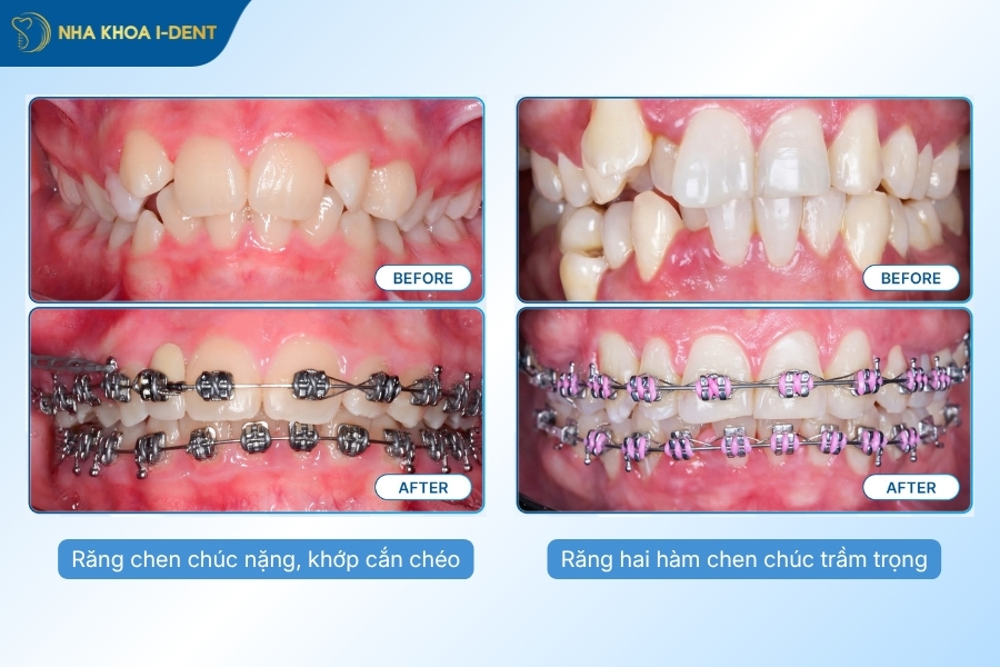 niềng răng tốn bao nhiêu tiền