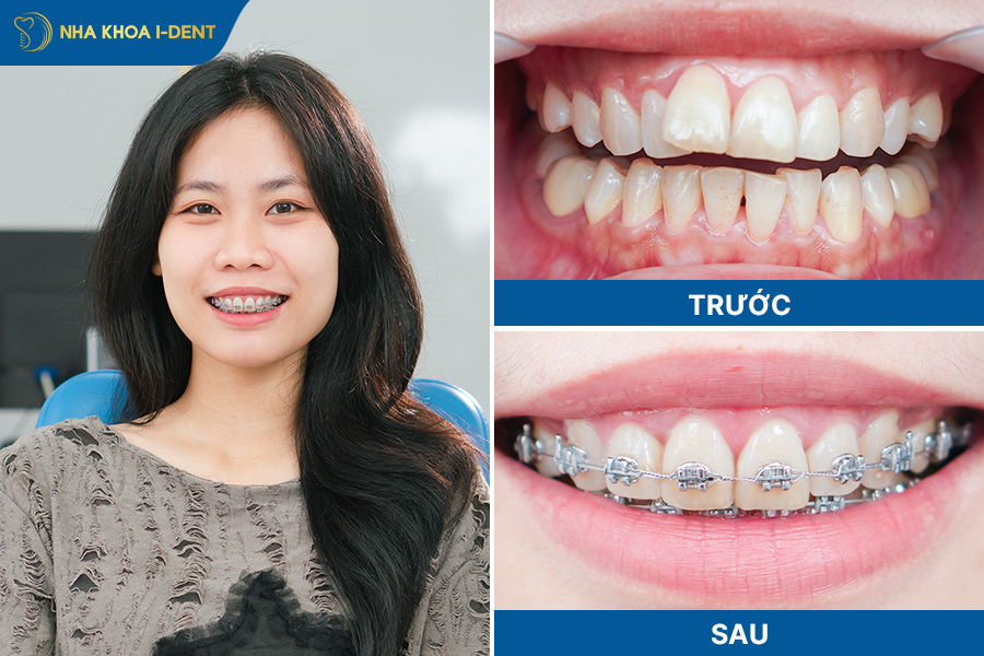 niềng răng mắc cài kim loại bao nhiêu tiền