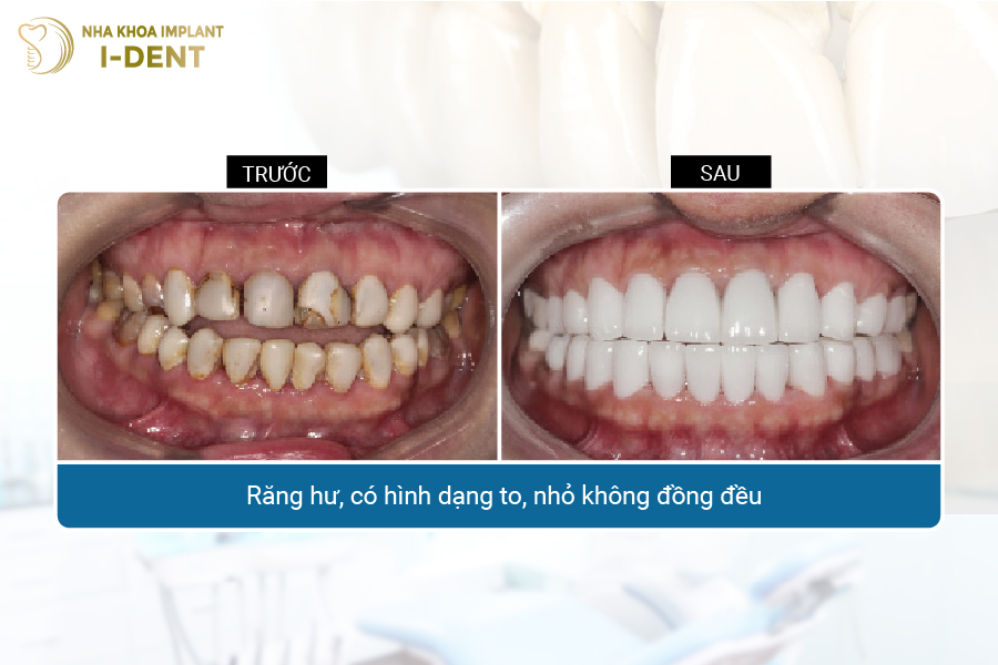 Bọc răng sứ giúp cải thiện thẩm mỹ răng hư, không đều giúp răng trắng sáng đều đẹp hơn.