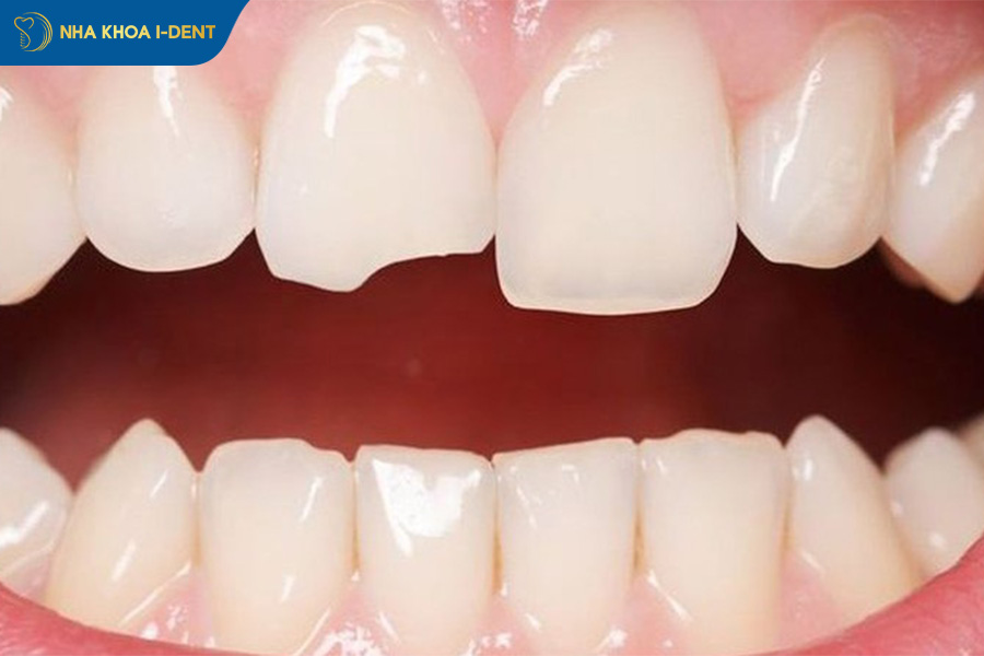 hậu quả bọc răng sứ