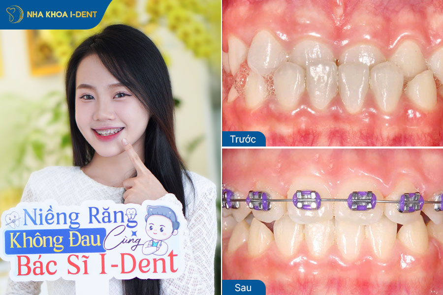 Hình ảnh sau khi niềng răng móm