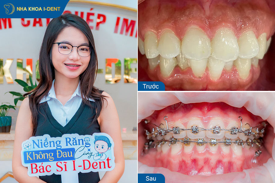 Hình ảnh sau khi niềng răng hô